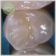 Smile Gallery Composite Restorations After