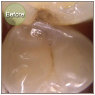 Smile Gallery Composite Restorations Before