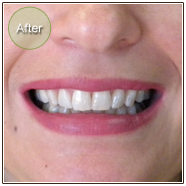 Smile Gallery In Office Teeth Whitening After Photo