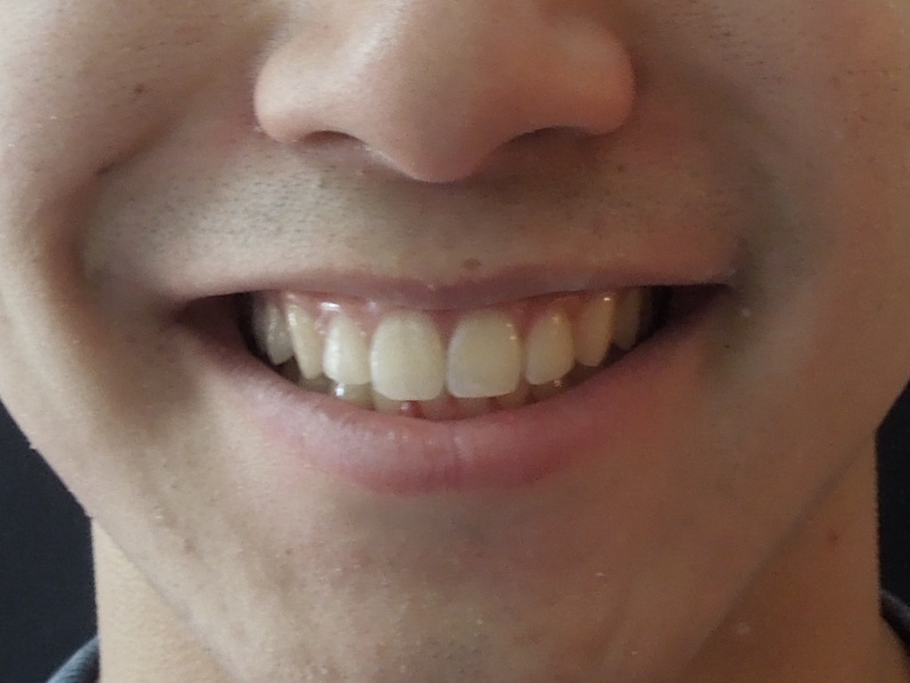 Smile Gallery Orthodontics After