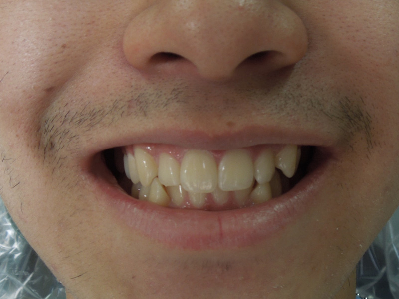 Smile Gallery Orthodontics Before